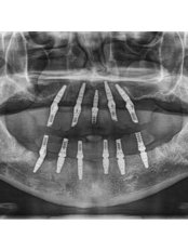 Dental Implants - Top Smile by Dr Omar Lugo