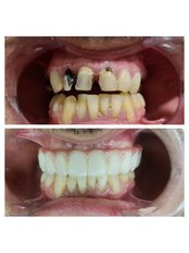 All-on-4 Dental Implants - Top Smile by Dr Omar Lugo