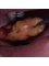 im.perio Dental - Bucal fat pad removal 