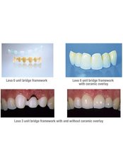 Dental Bridges - ImplArt Dentistry®