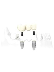 Implant Bridge - ImplArt Dentistry®
