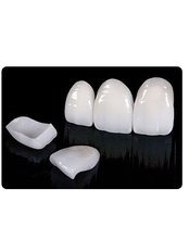 Veneers - ImplArt Dentistry®