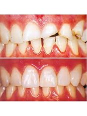 Veneers - Dental Max Clinic