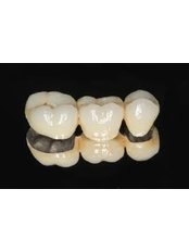 3-Unit Bridge - Dental Max Clinic