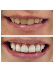 Composite Veneers - Dental Max Clinic