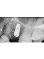 Dental Implants - Dental TV