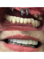 Dental Implants - Digital Dentists