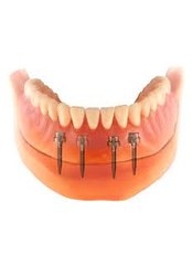 Mini Implants - Jabal Dental