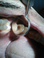 White Filling - Jabal Dental