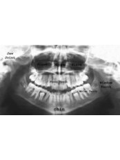 Panoramic Dental X-Ray - Jabal Dental