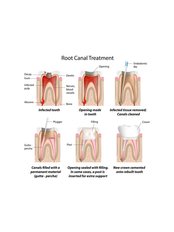 Single Visit Root Canal - Jabal Dental