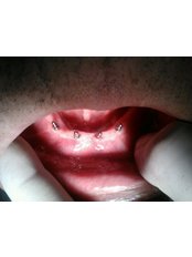 Mini Implants - Jabal Dental