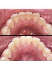 Teeth Cleaning - Dra Andrea Clark