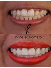 Veneers - Dra. Vanessa Romero