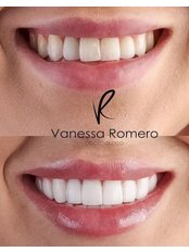 Porcelain Veneers - Dra. Vanessa Romero