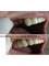 Rio Grande Dental Dentist Mexico - Before and after picture Rio Grande Dental 