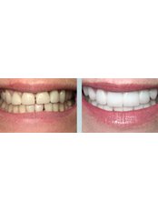 Veneer - Ultradent Dental Clinic