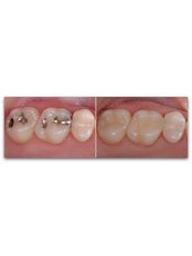 Dental Bonding - Dr. Francisco Javier Rebollar García