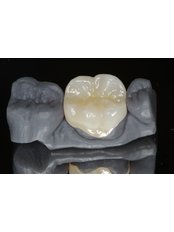 Dental Crowns - Dr. Francisco Javier Rebollar García