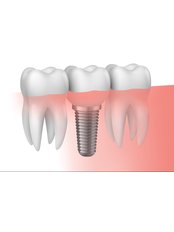 Dental Implants - Dr. Francisco Javier Rebollar García