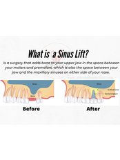 Sinus Lift - Alberta Dental