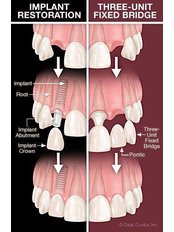 Dental Bridges - Alberta Dental