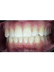 Teeth Whitening - BC Dental Clinic