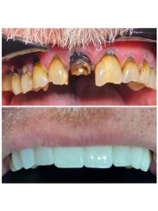 Dental Crowns - BC Dental Clinic
