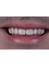 Composite Veneers - BC Dental Clinic