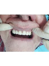 Zirconia Crown - BC Dental Clinic