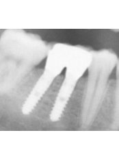 Dental Implants - Dental Laser Algodones