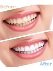 Teeth Whitening - Dental Laser Algodones