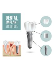 Dental Implants - DENTAL PLACE
