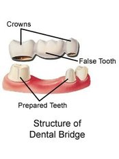 Dental Bridges - DENTAL PLACE