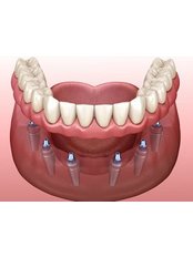 All-on-6 Dental Implants - DENTAL PLACE