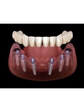 All-on-6 Dental Implants - Hope Professional Dental Clinic