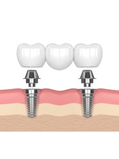 Implant Bridge - Hope Professional Dental Clinic