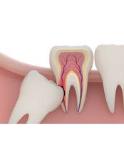 Wisdom Tooth Extraction - Molina's Dental Office