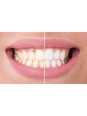 Teeth Whitening - Molina's Dental Office