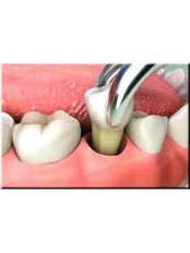 Surgical Extractions - Molina's Dental Office