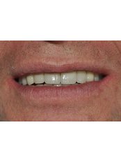 Dental Crowns - Nava Dental Care