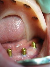 Overdentures - Nava Dental Care
