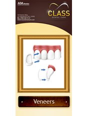 Veneers - Sani Dental Group Platinum