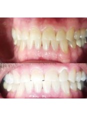 Teeth Whitening - Silber Dental Clinic