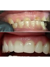 Zirconia Crown - Silber Dental Clinic