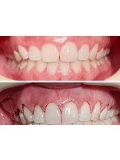 Gum Disease Treatmen - Silber Dental Clinic