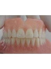 Acrylic Dentures - Simply Dental