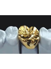 Gold Crown - Simply Dental