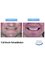 Simply Dental - Full Mouth Rehabilitation 