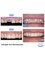 Simply Dental - Full Upper Arch Reconstruction 